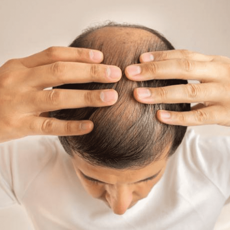 hair loss in men