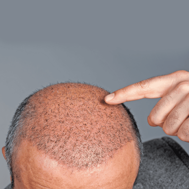 hair transplant