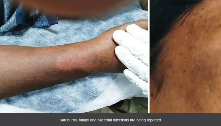 Red spots, infections on the skin? It’s mercury rising.