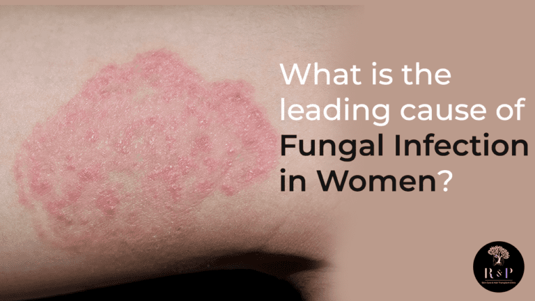 What is the leading cause of Fungal Infection in Women?