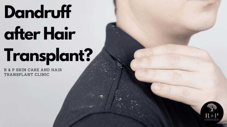 Is it normal to have dandruff after hair transplant treatment?