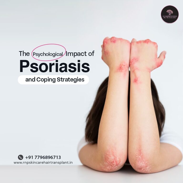 The Psychological Impact of Psoriasis and Coping Strategies