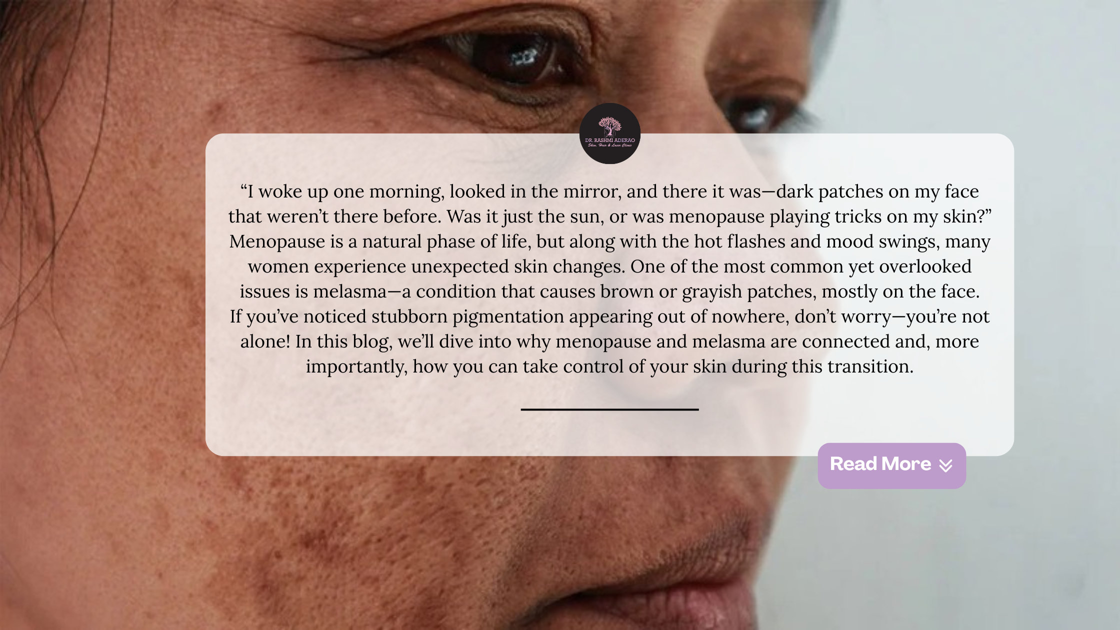 what-is-the-best-treatment-for-melasma