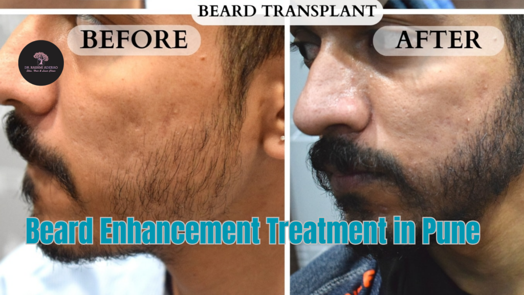 Beard Enhancement Treatment in Pune