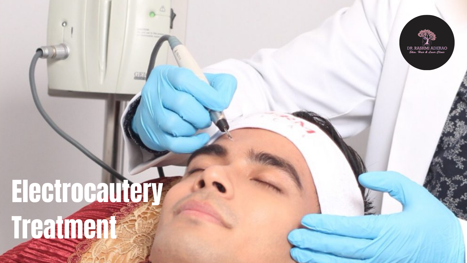 Electrocautery Treatment in Pune