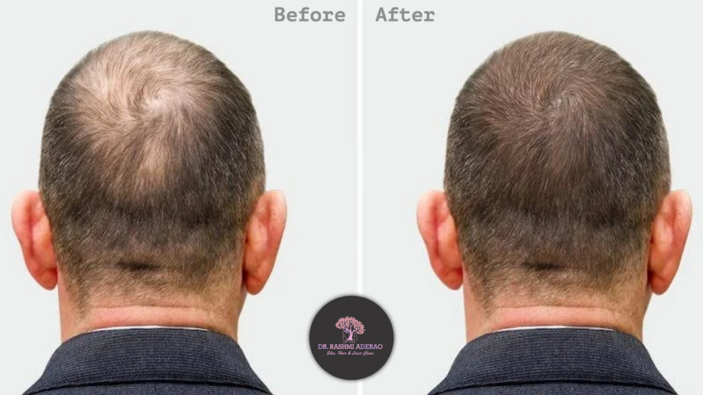 PRP Therapy for Hair in Kothrud Pune