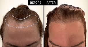 Long Hair Transplant