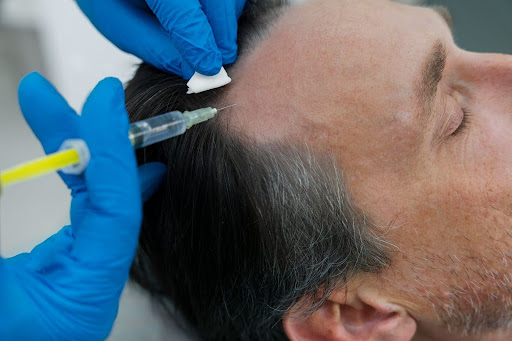PRP and GFC Hair Loss Treatment in Pune