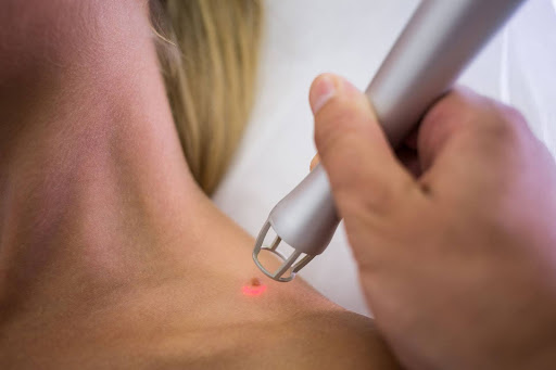 Electrocautery Treatment in Pune