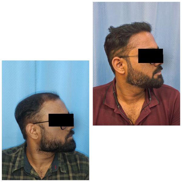 Hair Transplant Results before and after showing natural hairline improvement at Dr Rashmi Aderao Skin and Hair Clinic