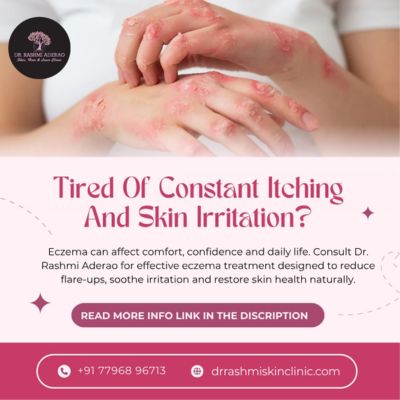 Eczema Treatment in Pune