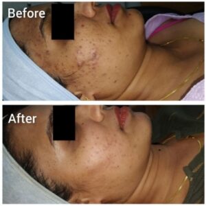 Pimple treatment Kothrud