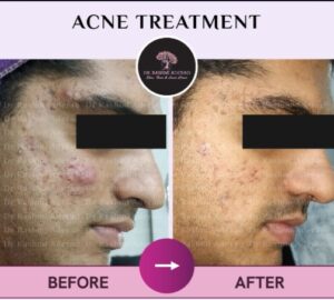 best acne doctor in Pune